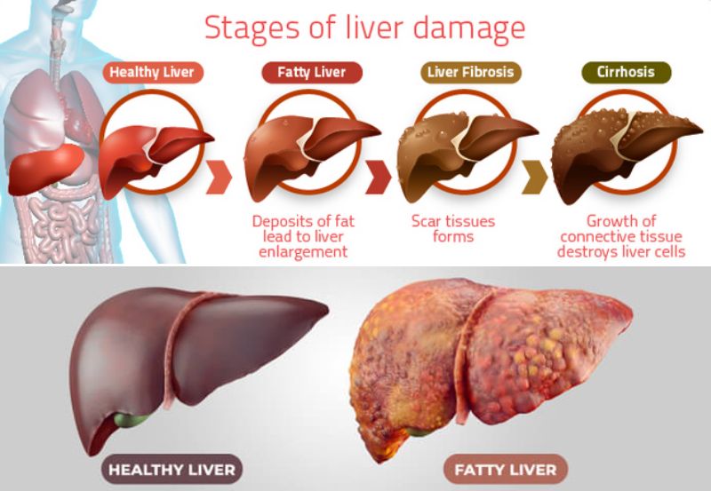 Fatty liver