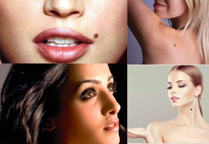 Mole(तिल ) on Your Body?