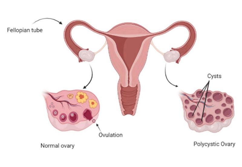 Polycystic Ovary Syndrome (PCOS)