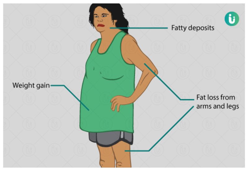 Cushing's syndrome