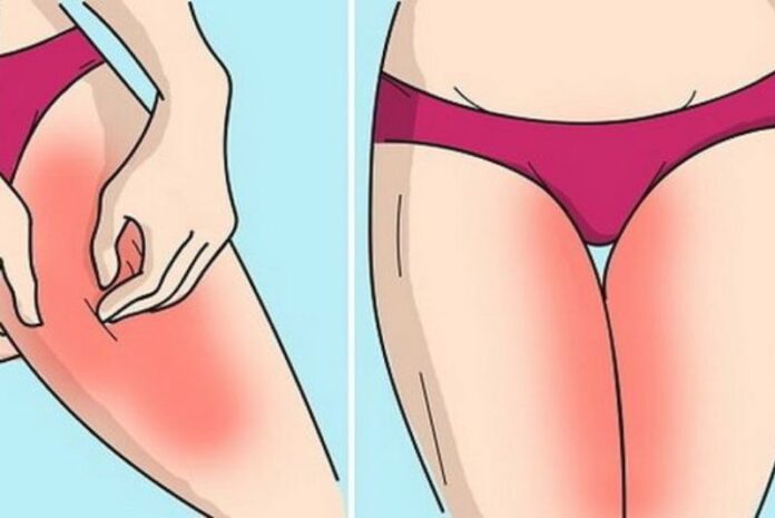 Inner thigh rashes